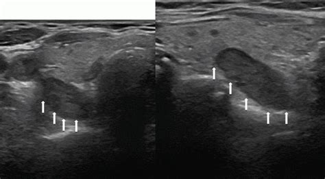 ultrasound soft tissue neck